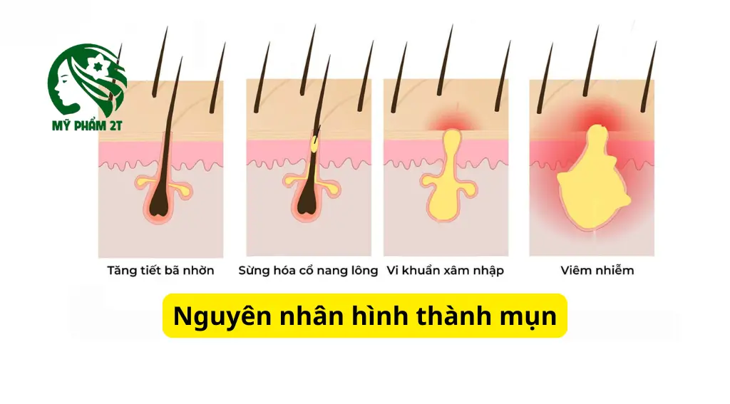 Da Mụn Là Gì? 5 Nguyên Nhân Hình Thành Mụn