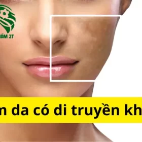 Di Truyền Có Ảnh Hưởng Đến Nám Da Không