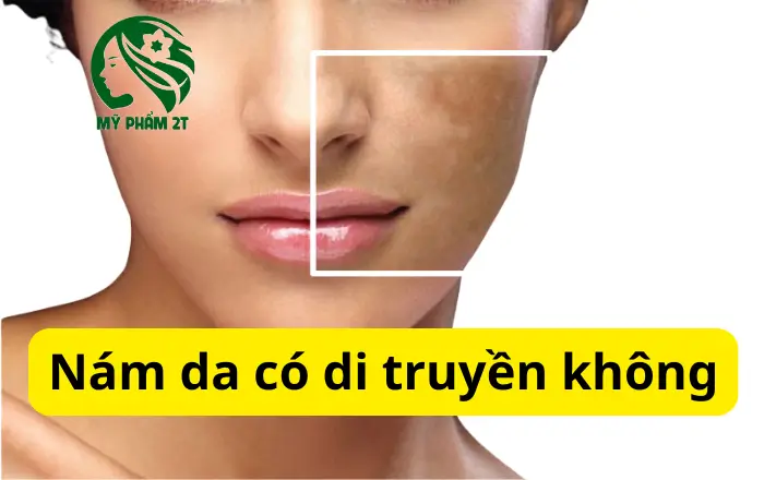 Yếu Tố Di Truyền Có Ảnh Hưởng Đến Nám Da Không?