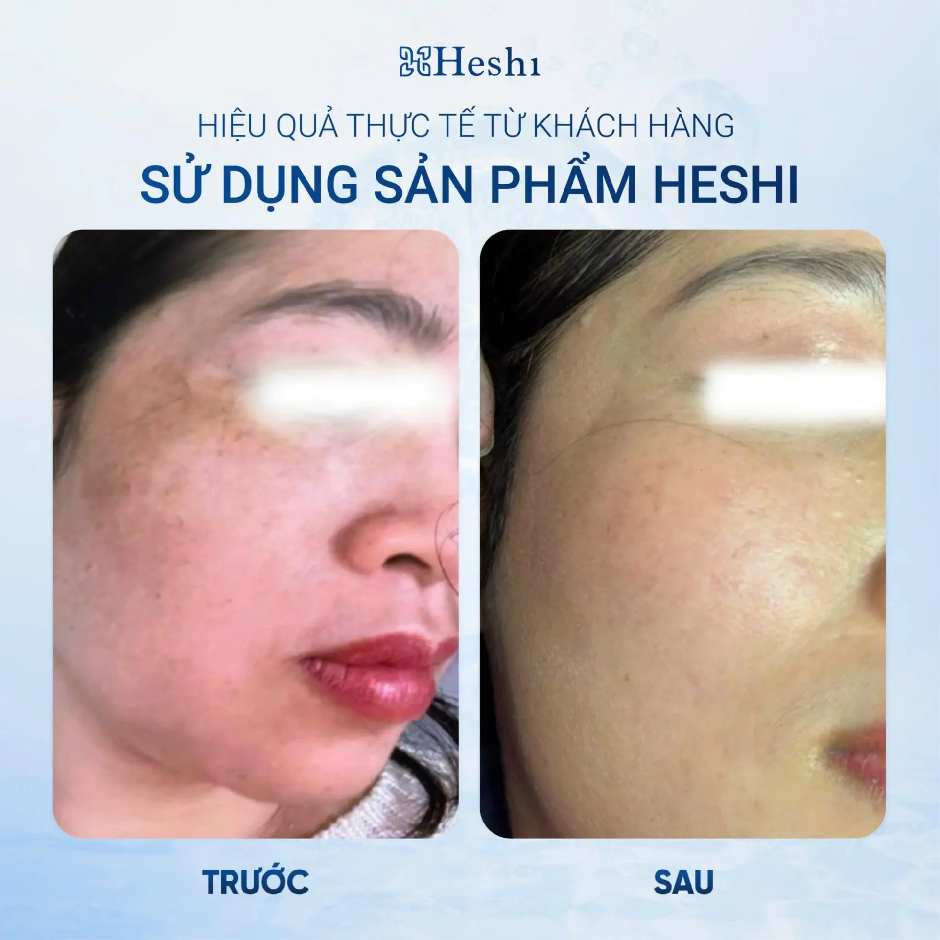 Bộ Ba Mờ Nám Sáng Da Heshi – Mờ Nám 50% Ngay Lần Đầu Sử Dụng 15 Bộ Ba Mờ Nám Sáng Da Heshi – Mờ Nám 50% Ngay Lần Đầu Sử Dụng 2