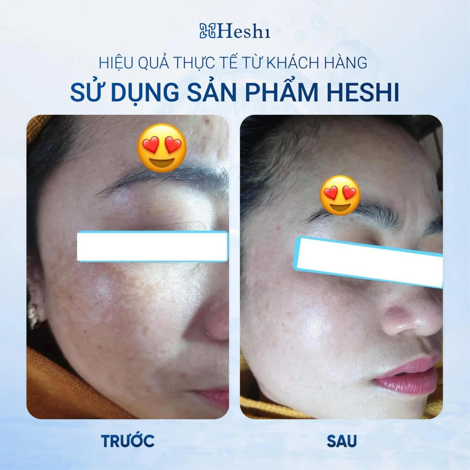 Bộ Ba Mờ Nám Sáng Da Heshi – Mờ Nám 50% Ngay Lần Đầu Sử Dụng 16 Bộ Ba Mờ Nám Sáng Da Heshi – Mờ Nám 50% Ngay Lần Đầu Sử Dụng 3