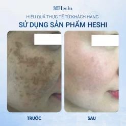 Ứng Dụng Serum Trị Liệu Ts 30 Brightening