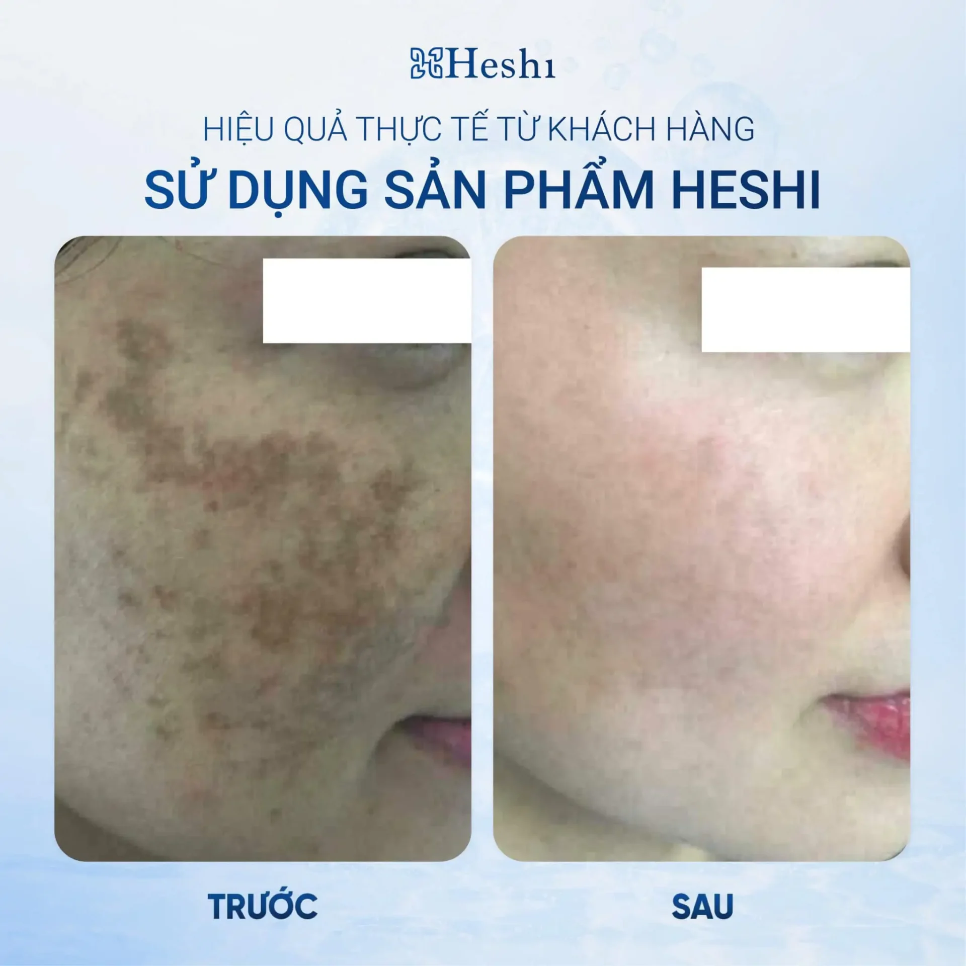 Bộ Ba Mờ Nám Sáng Da Heshi – Mờ Nám 50% Ngay Lần Đầu Sử Dụng 12 Ứng Dụng Serum Trị Liệu Ts 30 Brightening