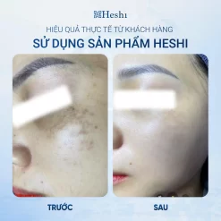 Serum Trị Nám Heshi Ultra Melasma Sáng Da, Giảm Thâm Nám Và Cải Thiện Độ Đàn Hồi Da  Ảnh 4