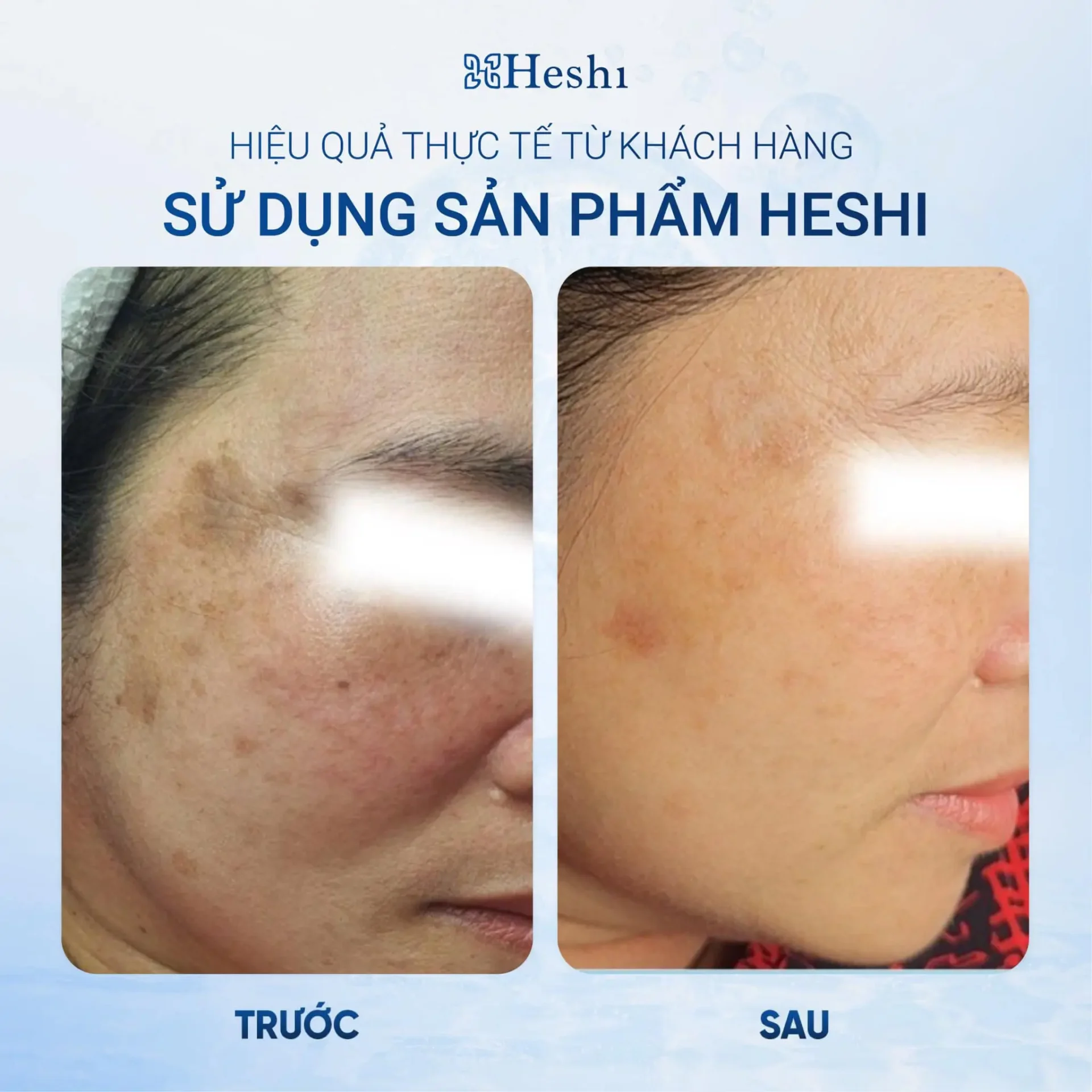 Bộ Ba Mờ Nám Sáng Da Heshi – Mờ Nám 50% Ngay Lần Đầu Sử Dụng 19 Bộ Ba Mờ Nám Sáng Da Heshi – Mờ Nám 50% Ngay Lần Đầu Sử Dụng 6