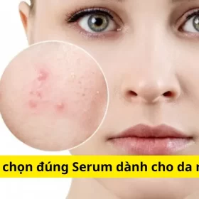 Hướng Dẫn Chọn Serum Cho Da Mụn