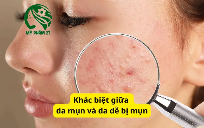 Da Mụn Và Da Dễ Bị Mụn Khác Gì Nhau? 99% Người Bị Mụn Nhầm!
