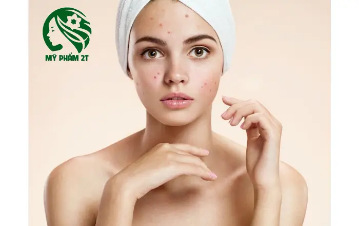 Lưu ý khi chọn mỹ phẩm cho da mụn & da dễ bị mụn