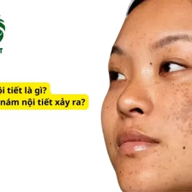 Nám Nội Tiết Là Gì?