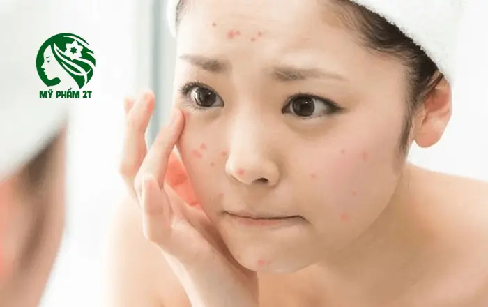 Nguyên nhân hình thành mụn