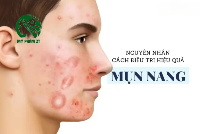nguyên nhân và cách điều trị mụn nang