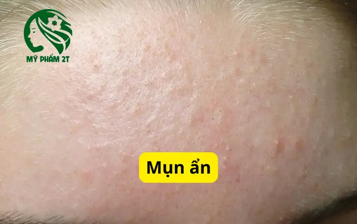 nhận biết mụn ẩn