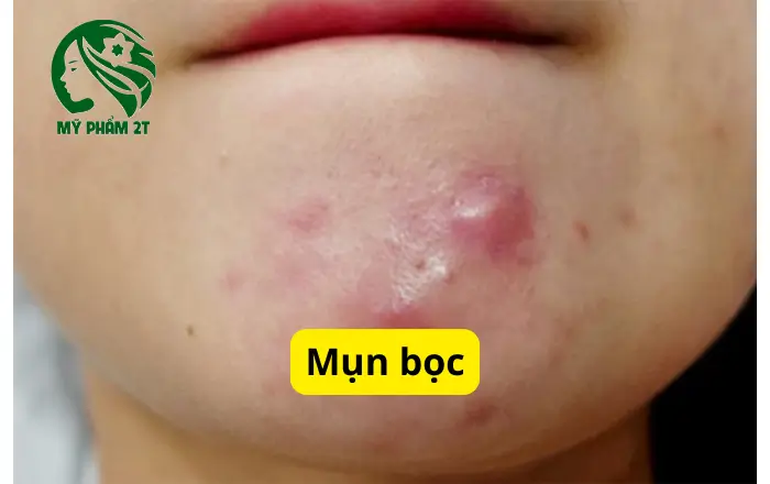 nhận biết mụn bọc