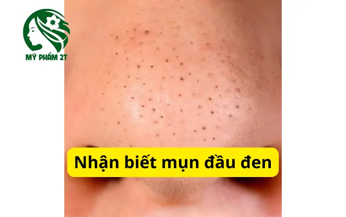 Cách nhận biết mụn đầu đen