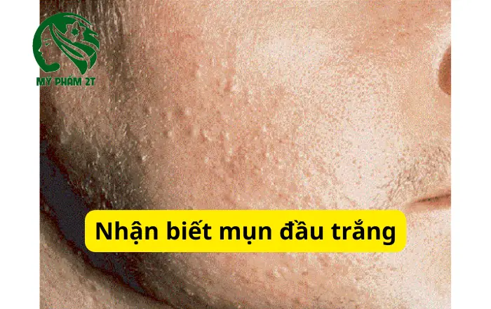 nhận biết mụn đầu trắng