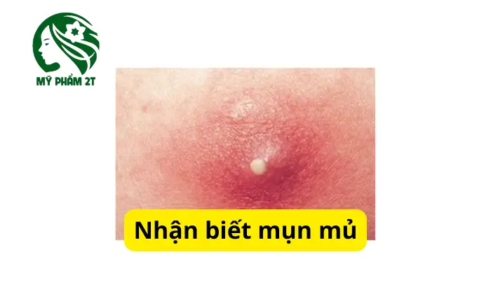 nhận biết mụn mủ