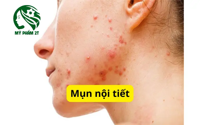 nhận biết mụn nội tiết