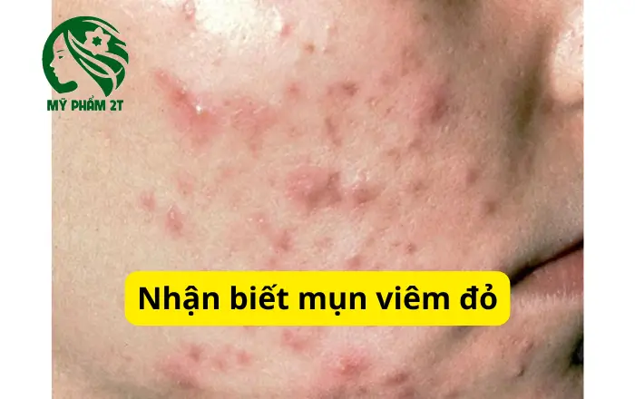 Nhận biết mụn viêm đỏ