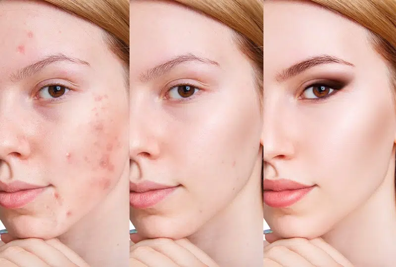 Chăm Sóc Da Mụn Đúng Cách Chăm Sóc Da Mụn Đúng Cách