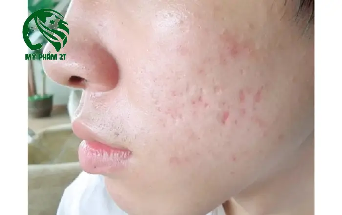 Sẹo lòi sẹo lõm do mụn