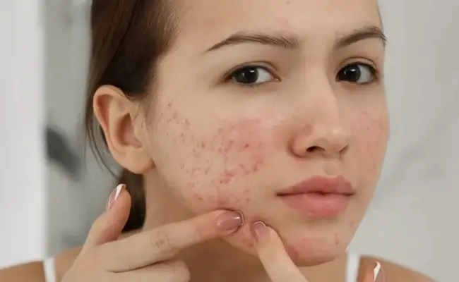 Sử dụng mỹ phẩm không phù hợp với da là nguyên nhân hình thành mụn