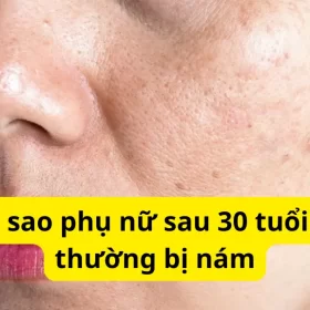 nám da thường gặp ở phụ nữ sau 30 tuổi