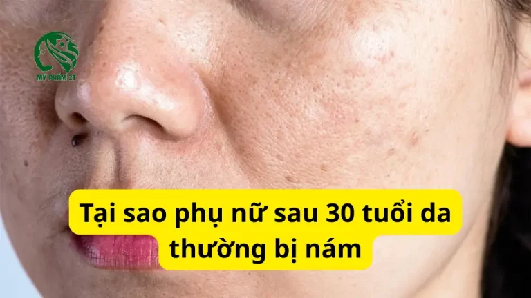 5 Lý Do Tại Sao Nám Da Thường Gặp Ở Phụ Nữ Sau 30 Tuổi?