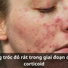 Thời Gian Phục Hồi Da Sau Thải Corticoid