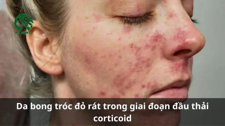 Thời Gian Phục Hồi Da Sau Thải Corticoid Mất Bao Lâu?