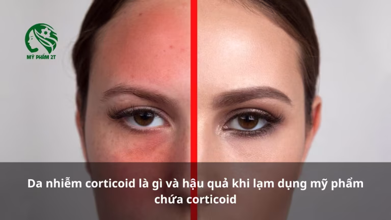 Da Nhiễm Corticoid Là Gì? Nguyên Nhân Và Cách Nhận Biết
