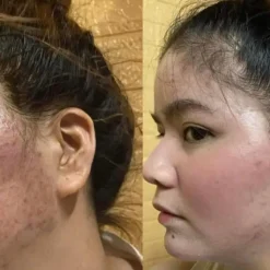 Kem Trị Mụn Thâm Acne – Giảm Mụn, Mờ Thâm Hiệu Quả 11 Feedback Dr Cell Từ Khách Hàng Thực Tế – Da Nám, Da Mụn Cải Thiện Rõ Rệt