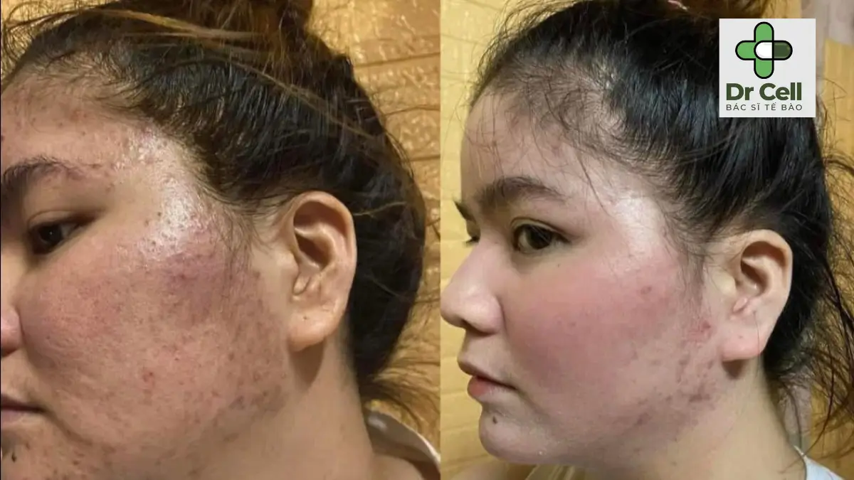 Feedback Dr Cell từ khách hàng thực tế – Da nám, da mụn cải thiện rõ rệt
