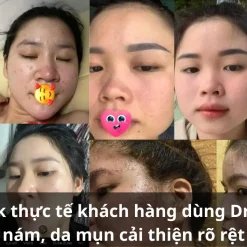 Kem Trị Mụn Thâm Acne – Giảm Mụn, Mờ Thâm Hiệu Quả 12 Feedback Thực Tế Khách Hàng Dùng Dr Cell – Da Nám, Da Mụn Cải Thiện Rõ Rệt