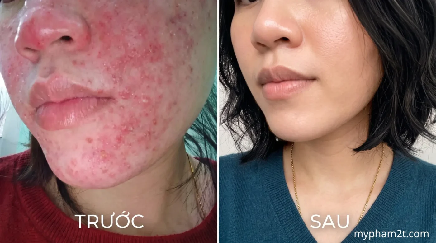 Thời Gian Phục Hồi Da Sau Thải Corticoid Mất Bao Lâu? Lộ Trình Chuẩn Y Khoa 5 Hình Ảnh Thực Tế Kết Quả Phục Hồi Da Nhiễm Corticoid Trước Và Sau Khi Điều Trị Đúng Cách, Làn Da Từ Bùng Mụn Mẩn Đỏ Trở Nên Láng Mịn Và Khỏe Mạnh.