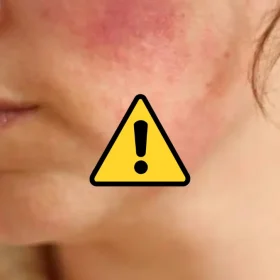 Sai Lầm Khi Thải Corticoid: Ngưng Corticoid Đột Ngột Khiến Da Đỏ Rát Và Viêm Nặng Hơn