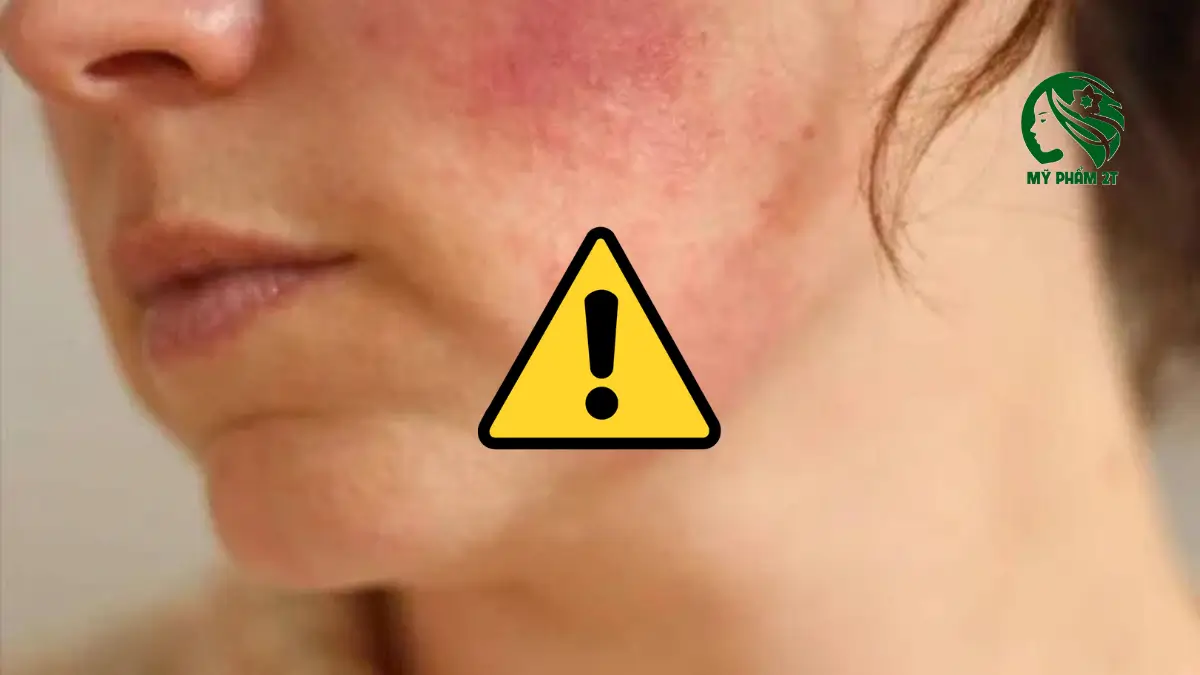 Sai lầm khi thải corticoid: ngưng corticoid đột ngột khiến da đỏ rát và viêm nặng hơn