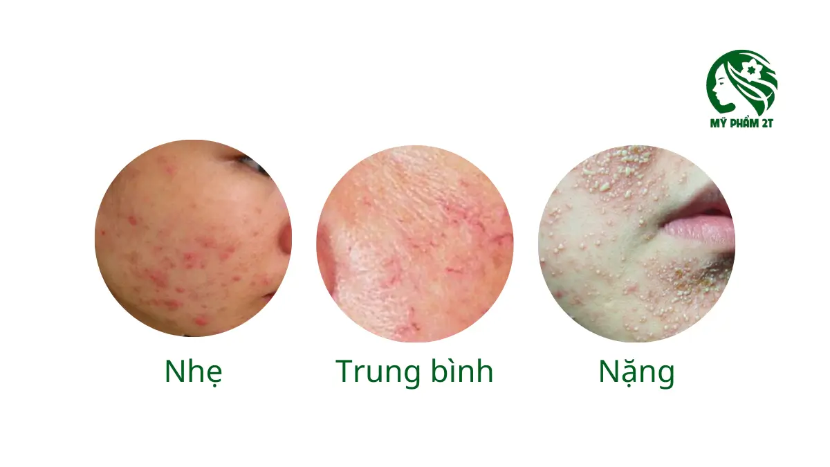 Phác đồ cá nhân hóa giúp thải corticoid an toàn và phù hợp từng tình trạng da