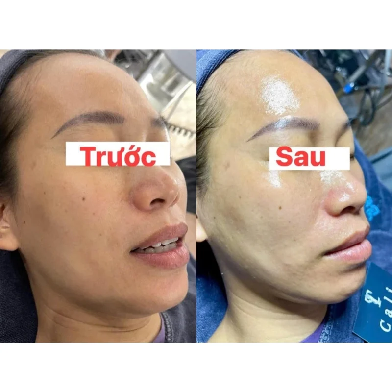 Trước Và Sau Liệu Trình Peel Mụn Nám Heshi