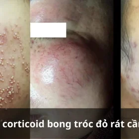 Da Nhiễm Corticoid Bong Tróc Đỏ Rát Cần Thải Độc