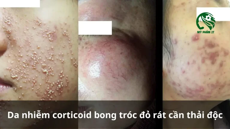 So Sánh Thải Corticoid Và Detox Da – Khác Biệt Và Hiệu Quả