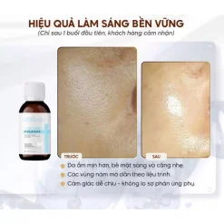 Trước và sau khi peel da bằng Meso Pro Melasma Heshi