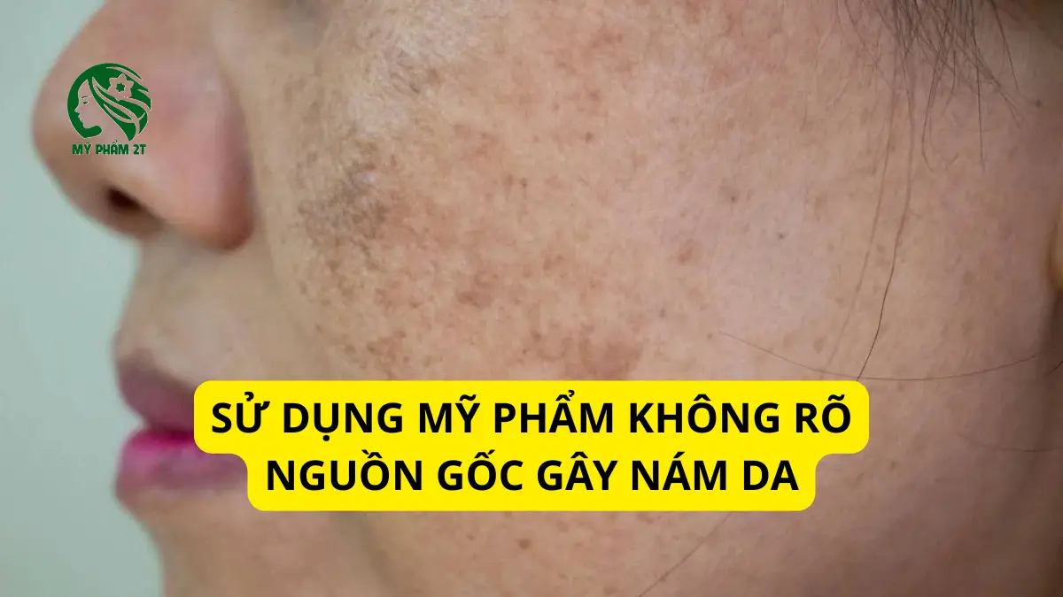 ảnh hưởng của mỹ phẩm không rõ nguồn gốc đến nám da