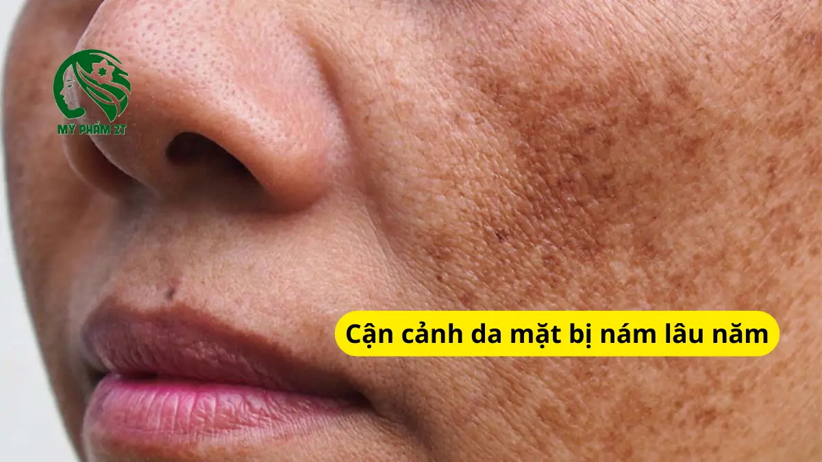 Cận cảnh da mặt bị nám lâu năm (gò má, trán)