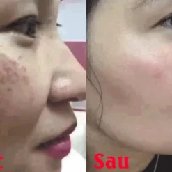 Da Nám Lâu Năm Cải Thiện Sau Khi Chăm Sóc Đúng Cách