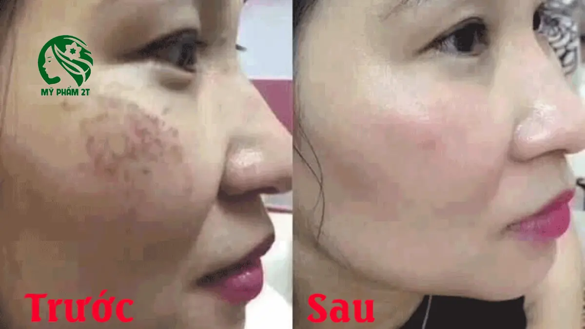 da nám lâu năm cải thiện sau khi chăm sóc đúng cách