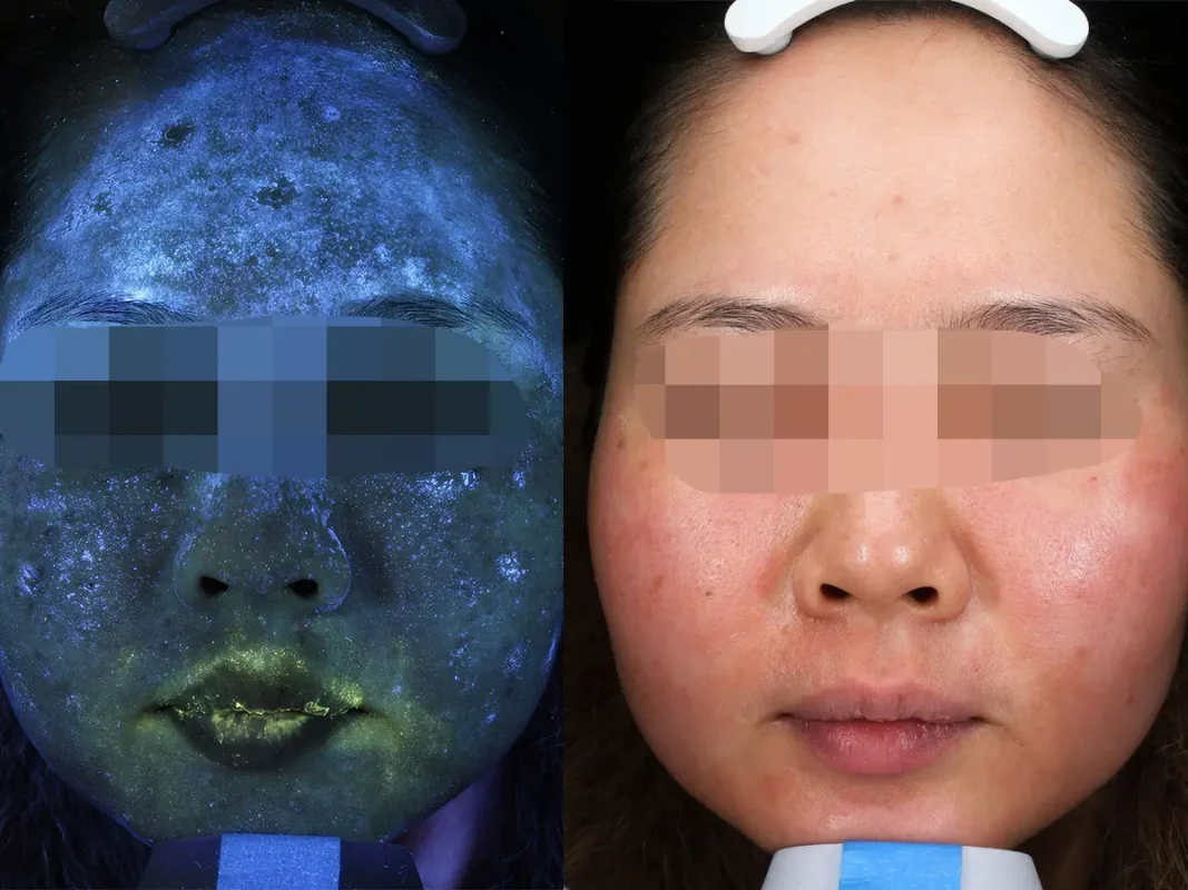 Mỹ phẩm không rõ nguồn gốc gây nám da, các hoạt chất bào mòn trong kem trộn phá hủy hàng rào bảo vệ, làn da sẽ suy yếu, da bị nhiễm độc corticoid