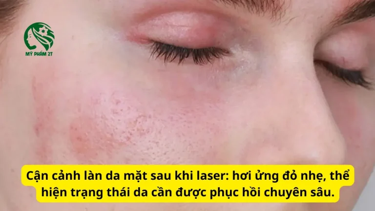 Sau Laser Nên Dùng Kem Phục Hồi Tốt Cho Da Sau Laser Nào Để Spa Tránh Thâm Sạm?