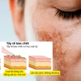 Tại Sao Tẩy Tế Bào Chết Quan Trọng Trong Điều Trị Nám