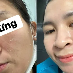 Các Loại Peel Da Tốt Nhất Hiện Nay Giúp Tái Tạo Da Sáng Khỏe
