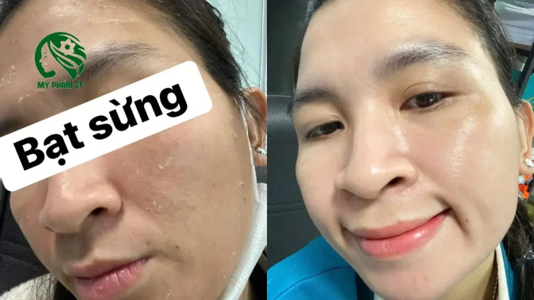 Các Loại Peel Da Tốt Nhất Hiện Nay – Nên Chọn Peel Nào An Toàn Và Hiệu Quả?